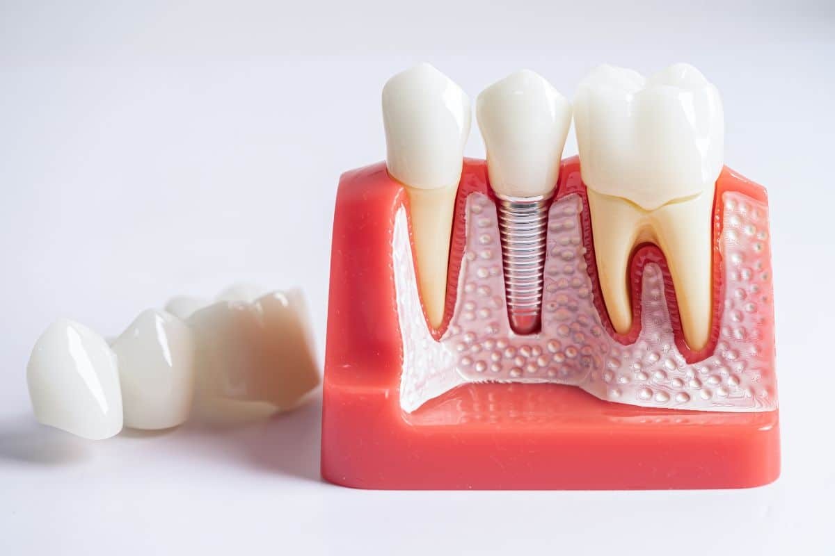 Dental Implants in Hamilton